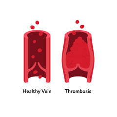Deep vein thrombosis for healthcare infographic. Vector flat illustration. Vascular disease diagnostic and treatment. Human healthy vein and DVT . Design for health care, education