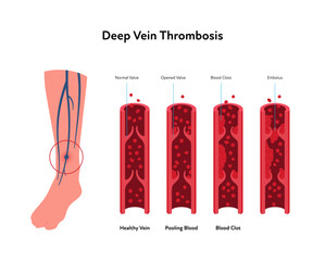 Deep vein thrombosis for healthcare infographic. Vector flat illustration. Vascular disease diagnostic and treatment. Human veins with DVT and blood clot. Design for health care, education