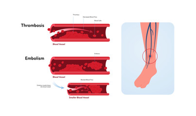 Deep vein thrombosis for healthcare infographic. Vector flat illustration. Vascular disease diagnostic and treatment. Human veins with DVT and blood clot. Design for health care, education