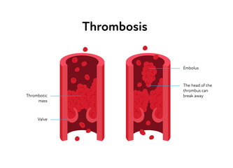 Deep vein thrombosis for healthcare infographic. Vector flat illustration with text label. Vascular disease diagnostic and treatment. Human healthy vein and DVT. Design for health care, education