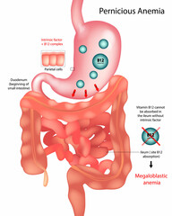 Educational medical illustration showing the mechanism of pernicious anemia. The diagram highlights the stomach's parietal cells that produce intrinsic factor, which is essential for vitamin B12 absor