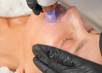 Close-up portrait of a beautiful aged woman during microneedling with dermapen from a beautician.