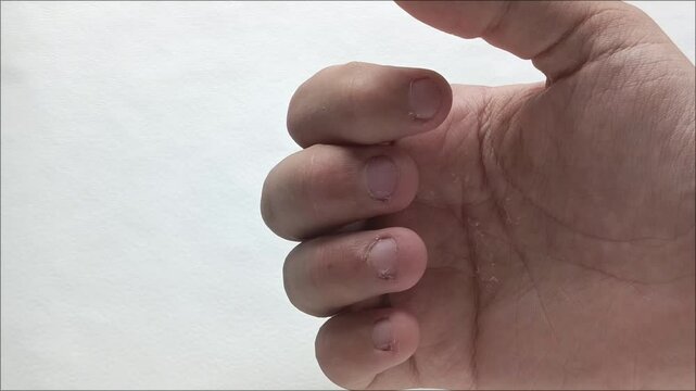 The bitten nails on the fingers of a teenage boy. Germs, bacteria under the nails. Podology.  