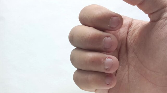 The bitten nails on the fingers of a teenage boy. Germs, bacteria under the nails. Podology. 