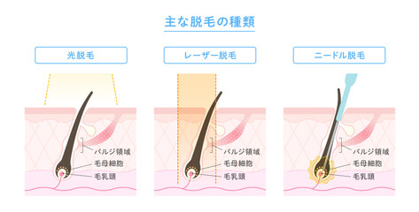 脱毛の種類 光脱毛・レーザー脱毛・ニードル脱毛