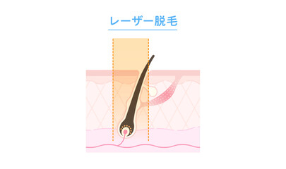 レーザー脱毛・医療脱毛のしくみ 断面図