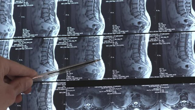 4k video of X-ray lumbar and thoracic hernias on human spine. Mri of diseases. Medical concept.