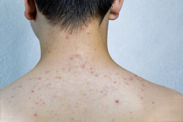 Naklejka premium Close up of back, shoulders, and neck of a teenage boy with visible acne and skin blemishes. This image highlights real, untreated skin, adolescence, real beauty, and skin condition awareness.