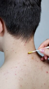 Mother treating acne on her teenage son's back, shoulders, and neck using a cotton swab dipped in acne remedy. A gentle skin care moment focusing on family care, hygiene, and dermatological treatment.