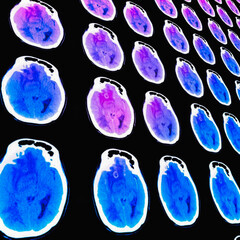 Axial computed tomography (CT) scan of the head showing an intra-axial tumour .brain tumor 