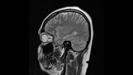 normal T2 sagital plane brain Magnetic resonance imaging (MRI)	