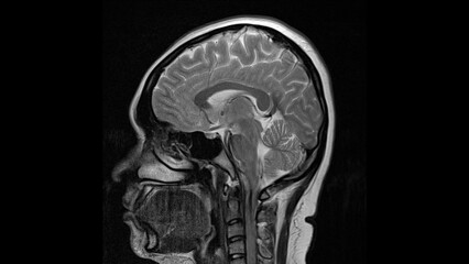 normal T2 sagital plane brain Magnetic resonance imaging (MRI)	