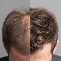 Transforming hair: a before and after comparison of hair loss treatment results for thinning and thick hair