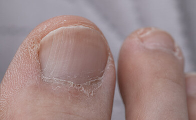 Dry neglected toenail with transverse longitudinal fissures close up