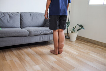 Rear View Of Unrecognized Male With Lymphatic Filariasis Standing On Wooden Floor