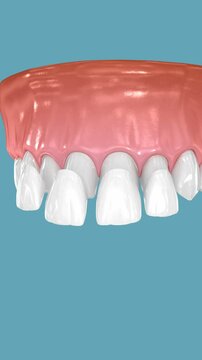 Dental veneers on blue background. 3D Animation