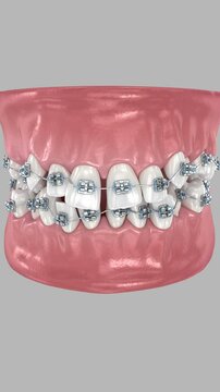 Abnormal teeth position and correction with braces. Dental 3D animation