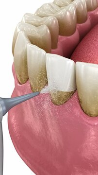 Oral hygiene: Air flow teeth cleaning process. Dental 3D animation
