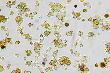Melanoma metastasis cells in the human brain.