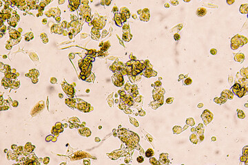 Melanoma metastasis cells in the human brain.