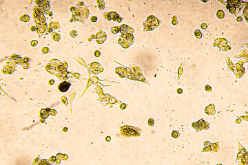 Melanoma metastasis cells in the human brain.