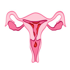 uterus en période menstruelle en couleur