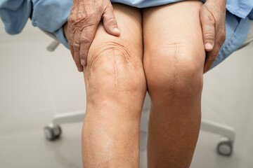 Asian elderly woman patient with scar knee replacement surgery in hospital.