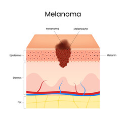 Melanoma Symptoms Diagram of Skin Cancer
