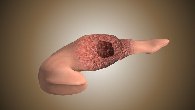 Pancreas affected by cancerous tumor