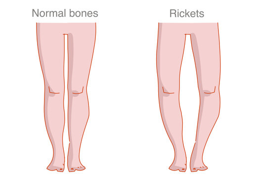 Rickets is the softening and weakening of bones in children .Vitamin D or calcium deficiency. Vector illustration.