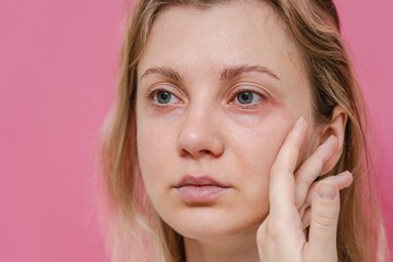 Young woman with itchy allergy or allergic sensitive reaction and red spot on her facial on pink background