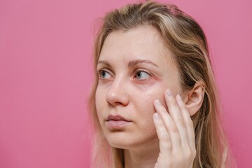 Young woman with itchy allergy or allergic sensitive reaction and red spot on her facial on pink...