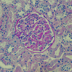 Camera photo of lupus nephritis, showing glomeruli with wire loop and hyaline thrombi,...