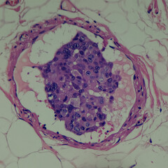 Camera photo of tumor (carcinoma) emboli in vascular channel, magnification 400x, photograph...
