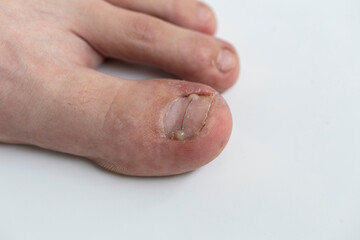 Podological brace from titanium thread on toe nail with onychocryptosis or ingrown toenail, orthonyxia treatment