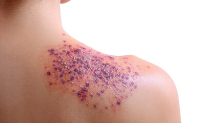 Shingles virus causing painful rash with blisters on back skin, isolated on transparent background, perfect for medical and healthcare publications