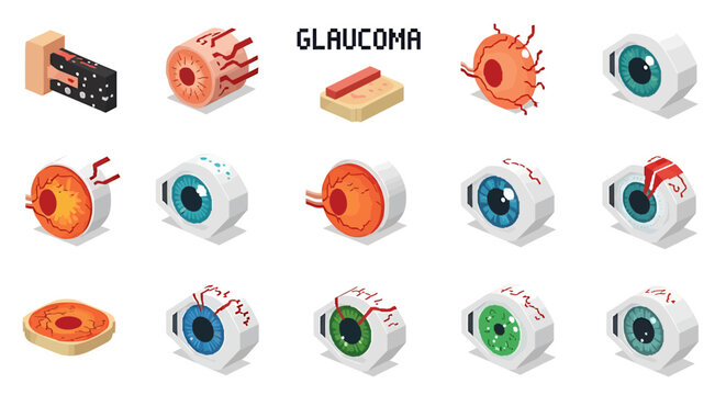 Vector Icons Set of Isometric Illustrations of Glaucoma Detailing Eye Anatomy and Disease Progression. Vector Illustrations