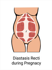 Diastasis Recti during pregnancy. The anatomy of a Woman. A woman's muscular corset during childbirth. Vector illustration
