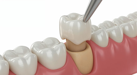 Photorealistic 3D Render of Zirconium Dental Crown Placement on Prepared Tooth Stump
