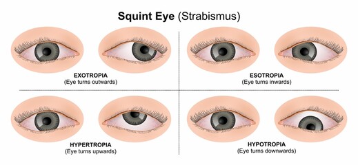 Squint Eye (Strabismus) Illustration eye