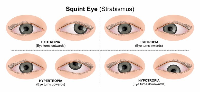 Squint Eye (Strabismus) Illustration eye