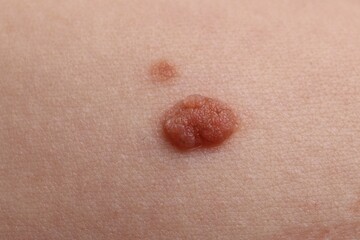 Fototapeta premium Woman with moles on her body, closeup