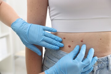 Doctor examining woman's moles in hospital, closeup