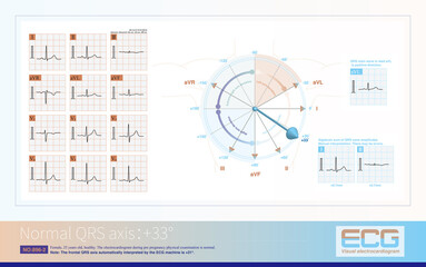 When the frontal plane axis is at+33 °, the maximum QRS excitation potential is most perpendicular...