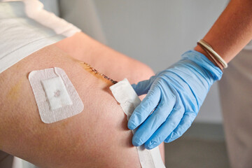Nurse applies new bandages to a patient’s knee following arthroscopic surgery. Hospital postoperative care process involving wound inspection and protection for healing and recovery.