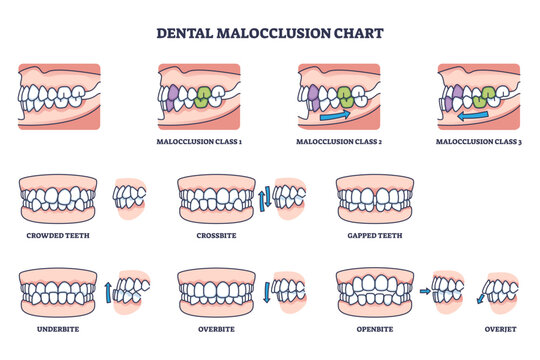 Dental malocclusion chart shows types of teeth misalignment, including overbite, underbite, and crossbite, transparent background.