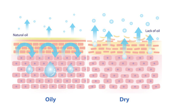The mechanism of oily and dry skin vector illustration. Comparison of natural oil on skin layer acts as an occlusive, less trans epidermal water loss. And lack of oil on skin causes more TEWL.