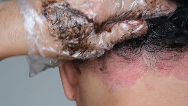 Is it permissible to dye hair on a scalp that is suffering from Psoriasis?