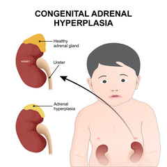 Congenital Adrenal Hyperplasia Kidney Illustration