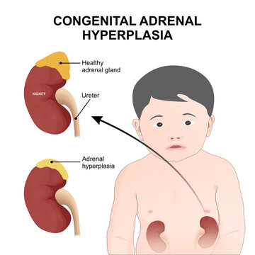 Congenital Adrenal Hyperplasia Kidney Illustration
